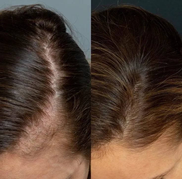 Hair PRP Microneedling