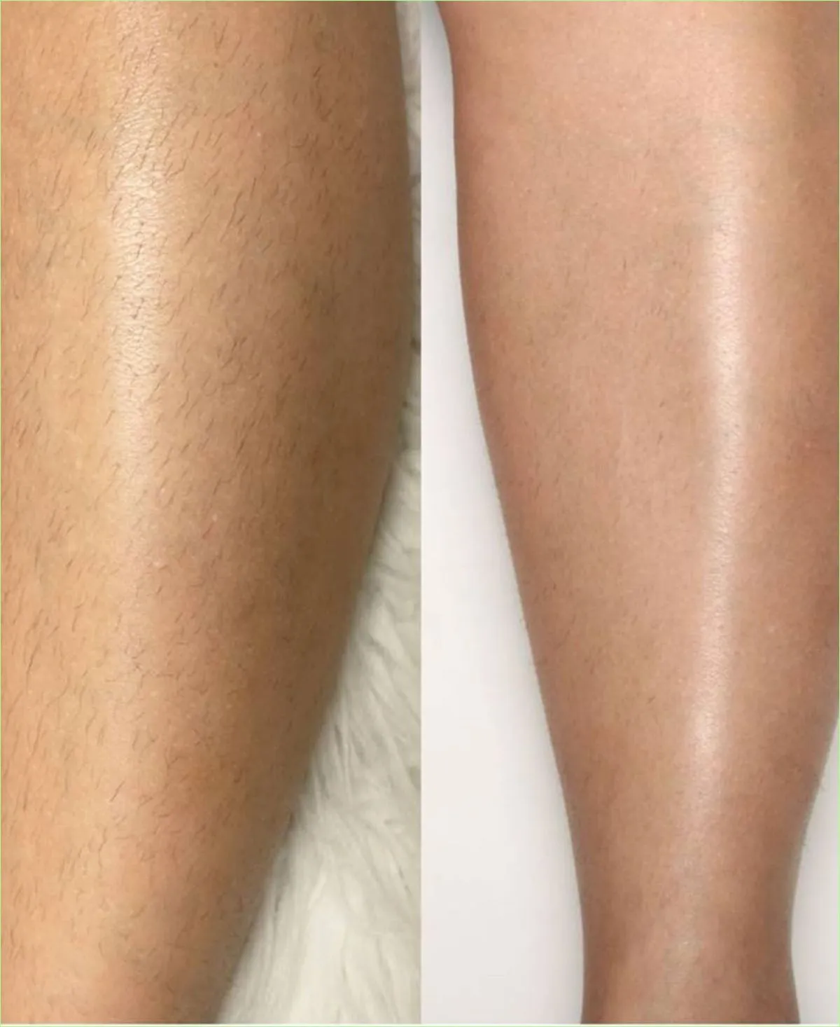 Laser Hair Reduction