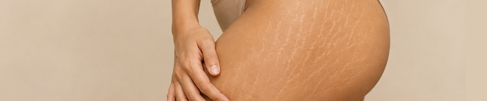Stretch Marks Management at KNK SKKIN
