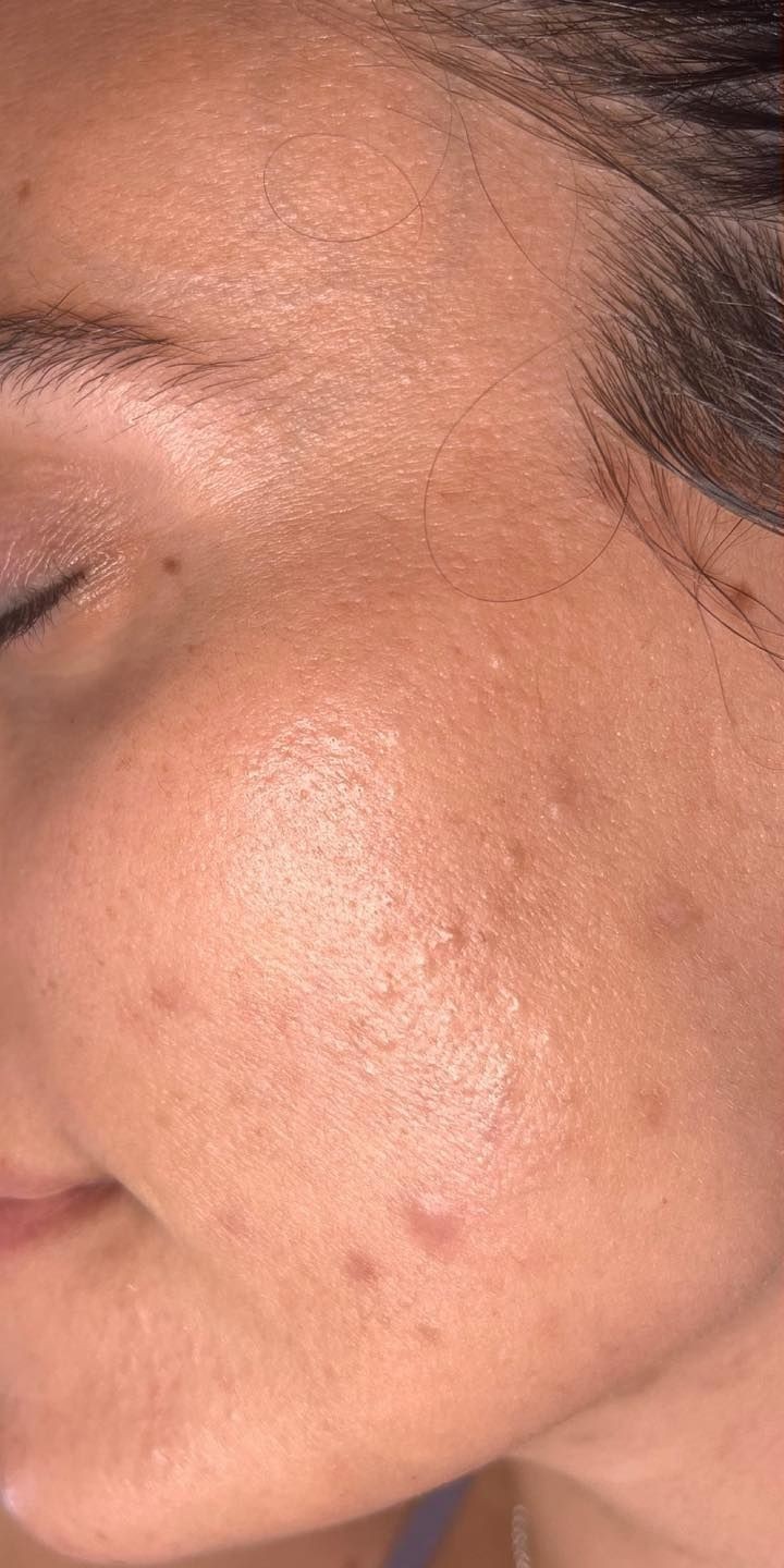 Before — Chemical Peel