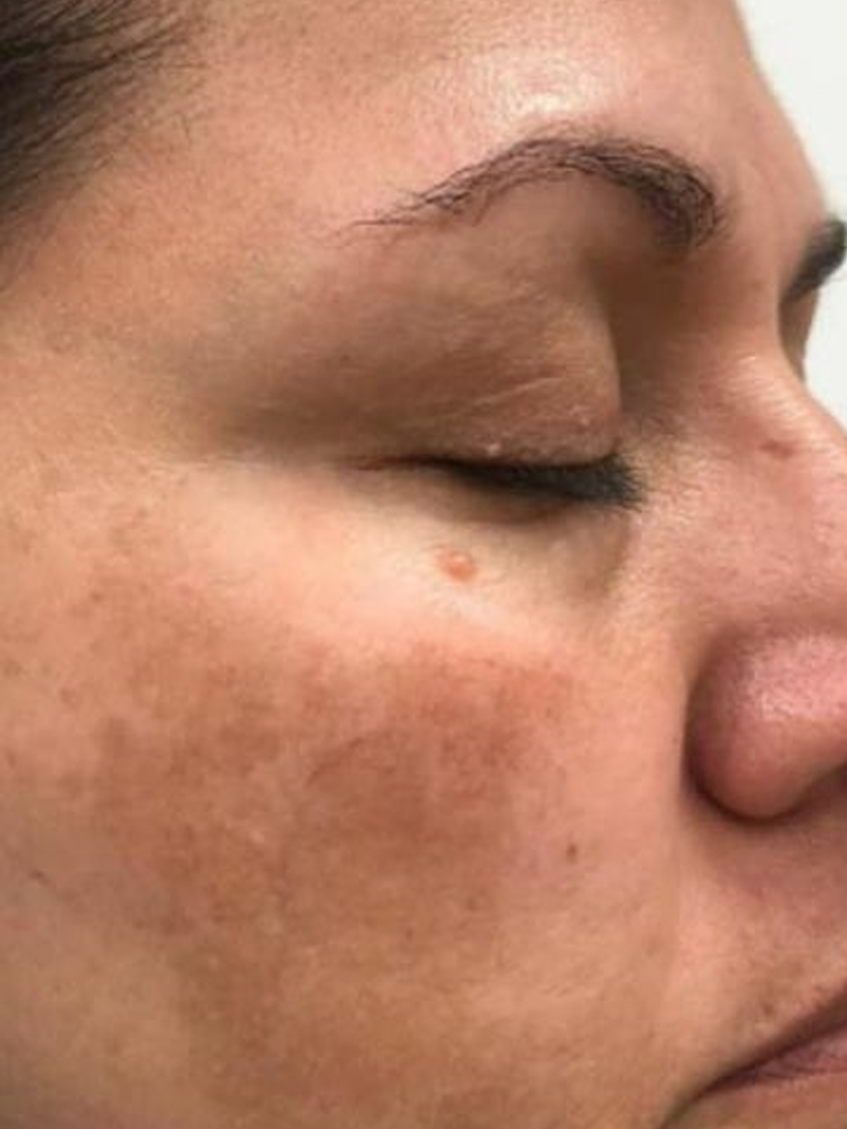 Before — Pigmentation Treatment